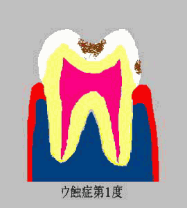 tooth C1