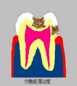 tooth C2