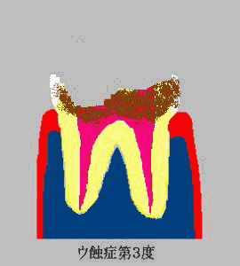 tooth C3