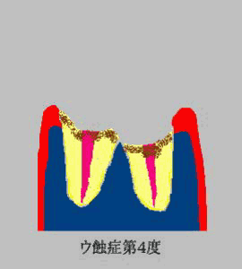 tooth C4